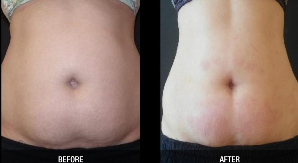 velashape-tummy-fat-removal-before-after.jpg
